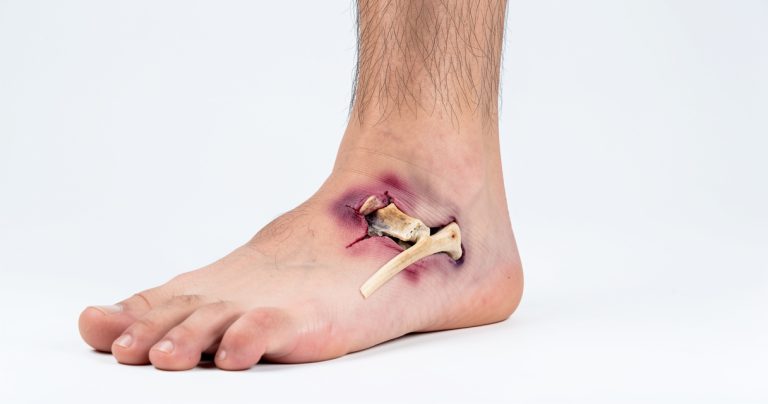 Arrachement osseux à la cheville : symptômes, traitements et temps de guérison (guide complet)