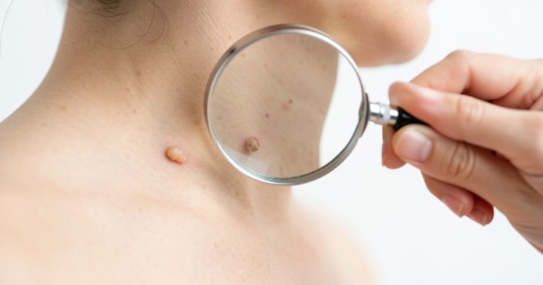 Lésions cutanées bénignes : acrochordons, kystes, lipomes, que faire ?