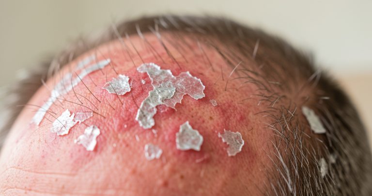 Psoriasis du cuir chevelu : symptômes et traitements 2026