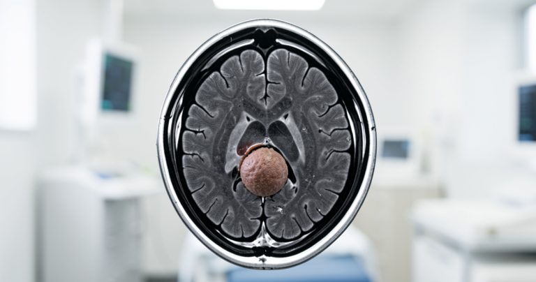 Tumeurs cérébrales : classification, diagnostic et traitements